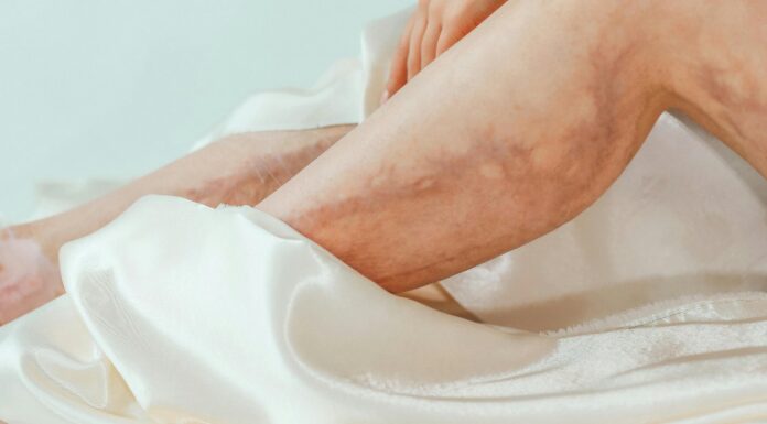 Šta je najbolje za prosirene vene? Noga sa istaknutim venama